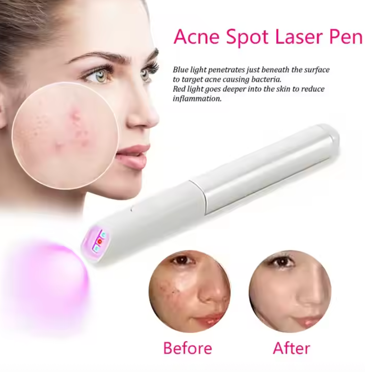 Red And Blue Light Therapy Acne Removal Laser Pen